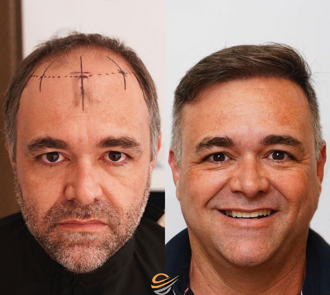 transplantacija kose