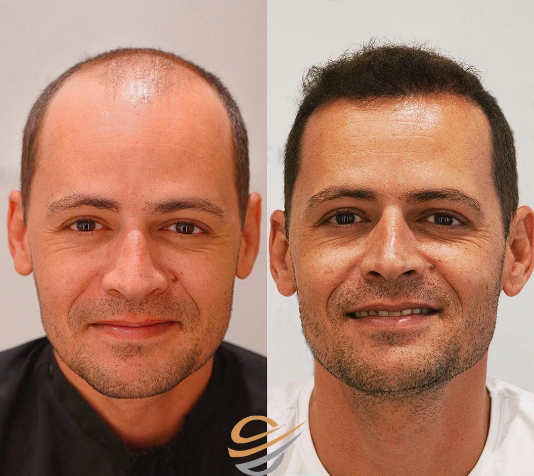 transplantacija kose