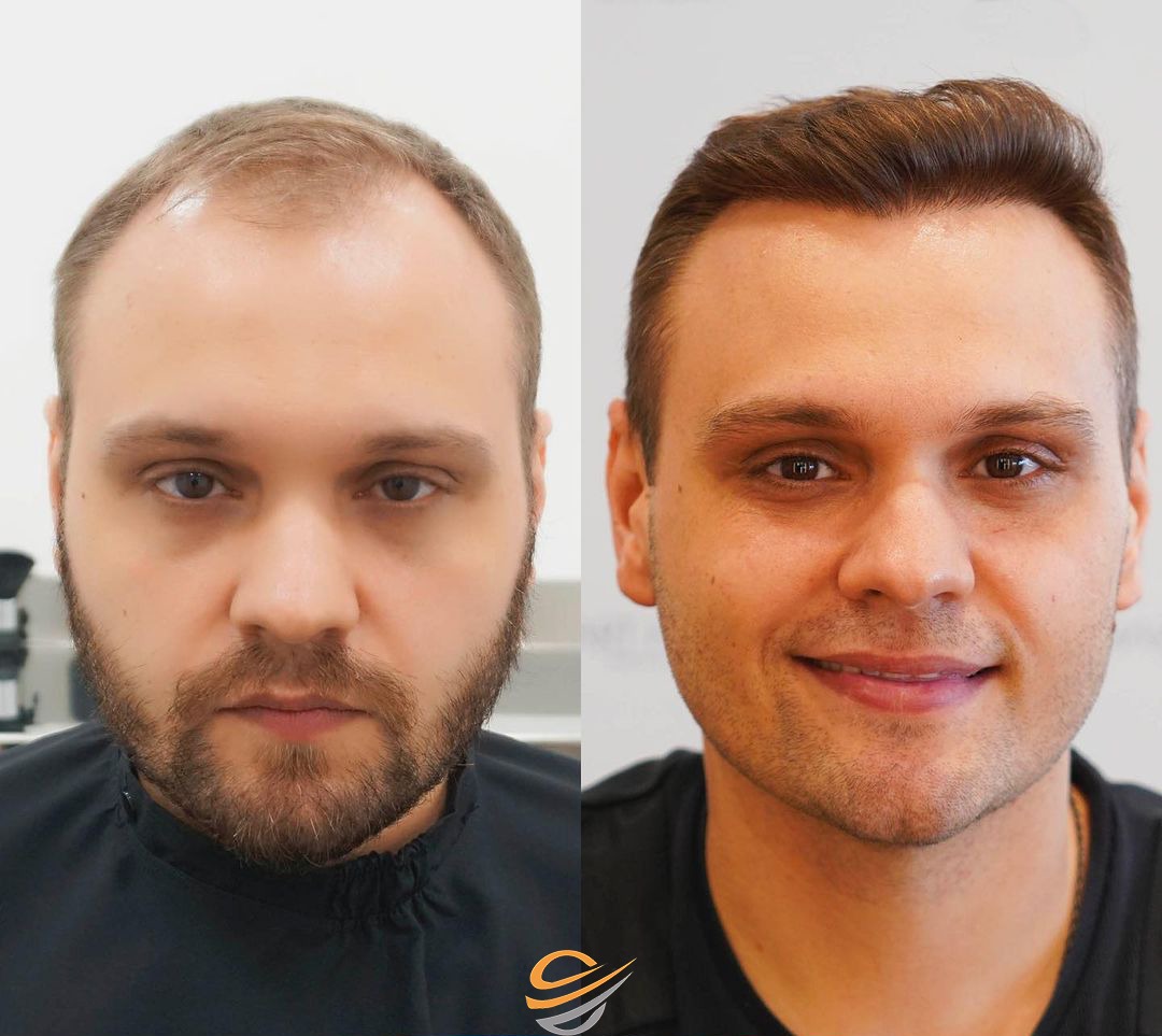 before after Transplantacija Kose