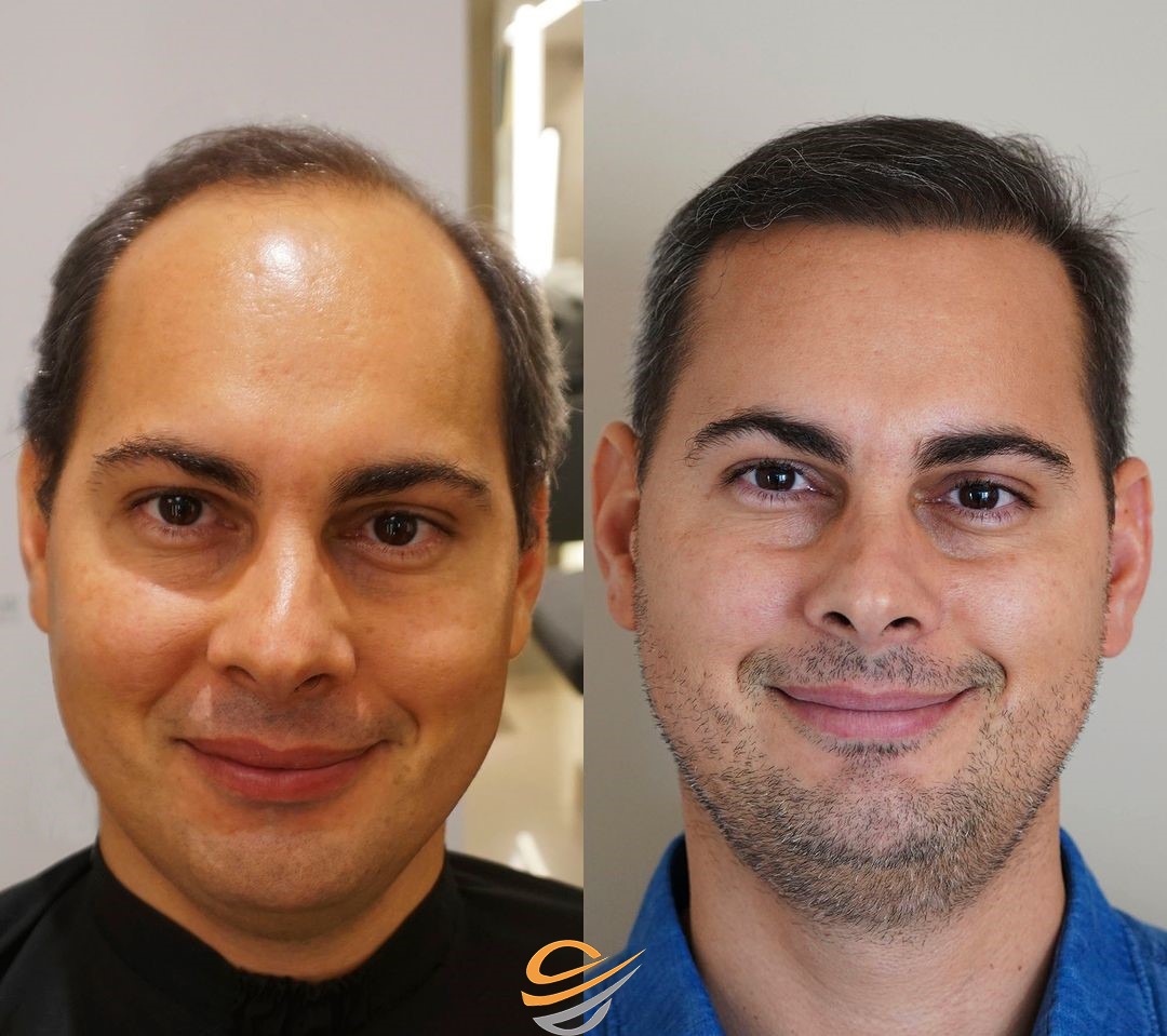 before after Transplantacija Kose