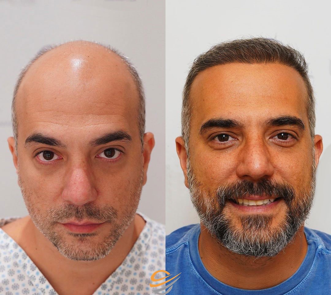 before after Transplantacija Kose