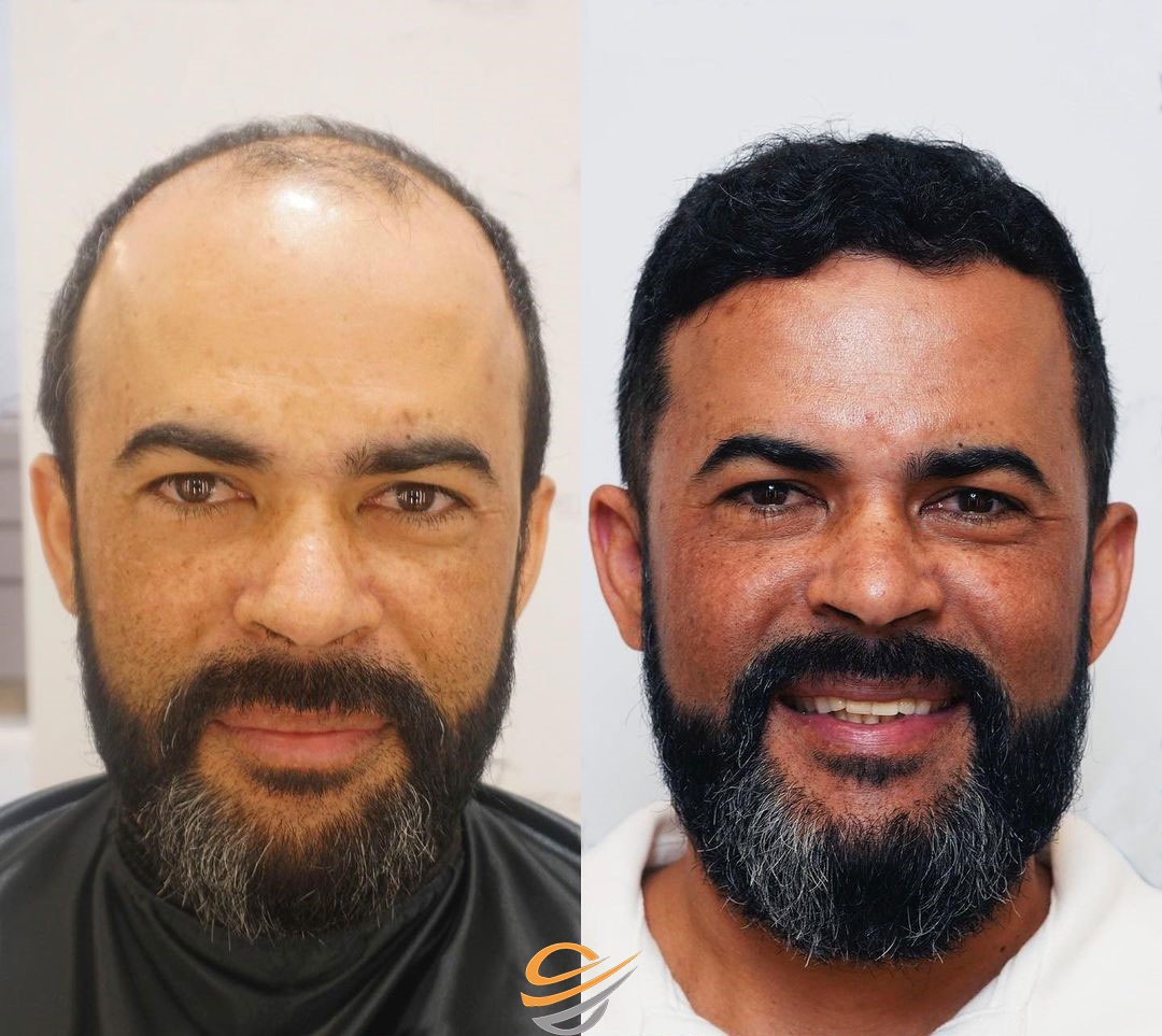 before after Transplantacija Kose